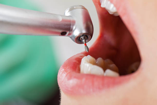 Best Emergency Tooth Extraction in Willow Creek, CA